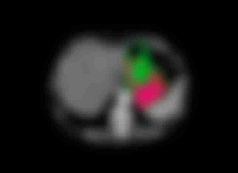Stomach Cancer CT Scan